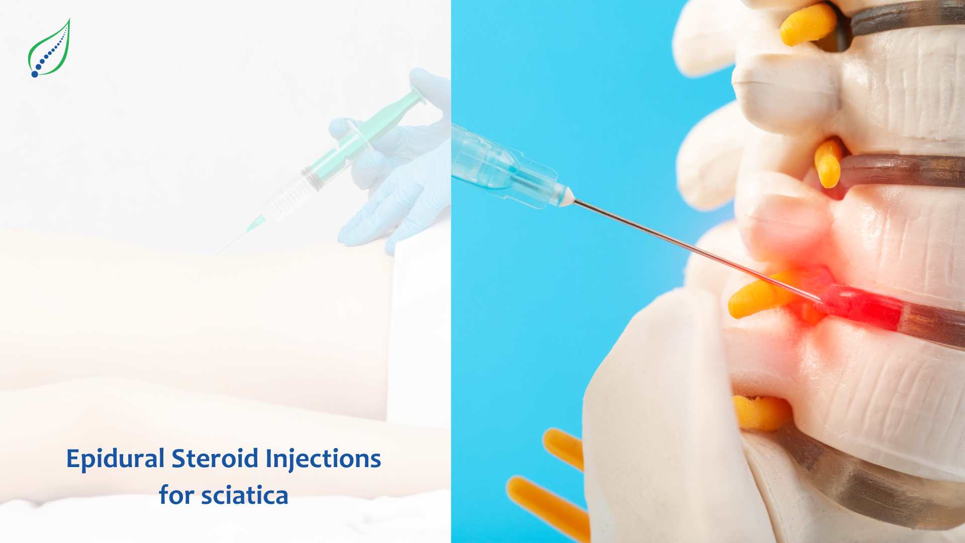 Epidural Steroid Injections For Sciatica